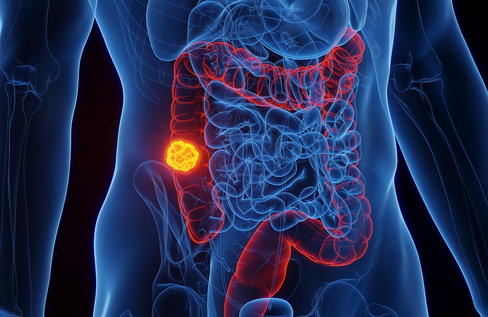 Darmkrebs - © Sebastian Kaulitzki - stock.adobe.com Darmkrebs - © Sebastian Kaulitzki - stock.adobe.com